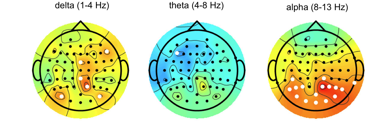 Dasgupta Parkinsons Publication EEG Figure