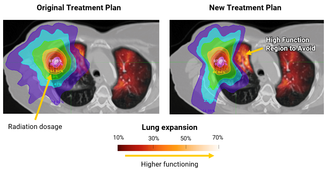 Two diagrams showing lung imaging scans: on the left the original radiation treatment plan and on the right the new treatment plan that avoids more of the high functioning area of the left lung