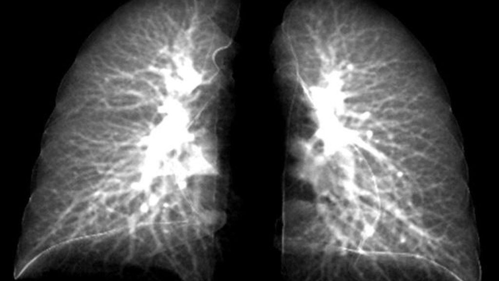 xray of lungs 